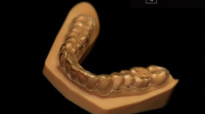 3D spausdintuvu pagamintas dantų modelis ir skaidri dantų tiesinimo kapa.