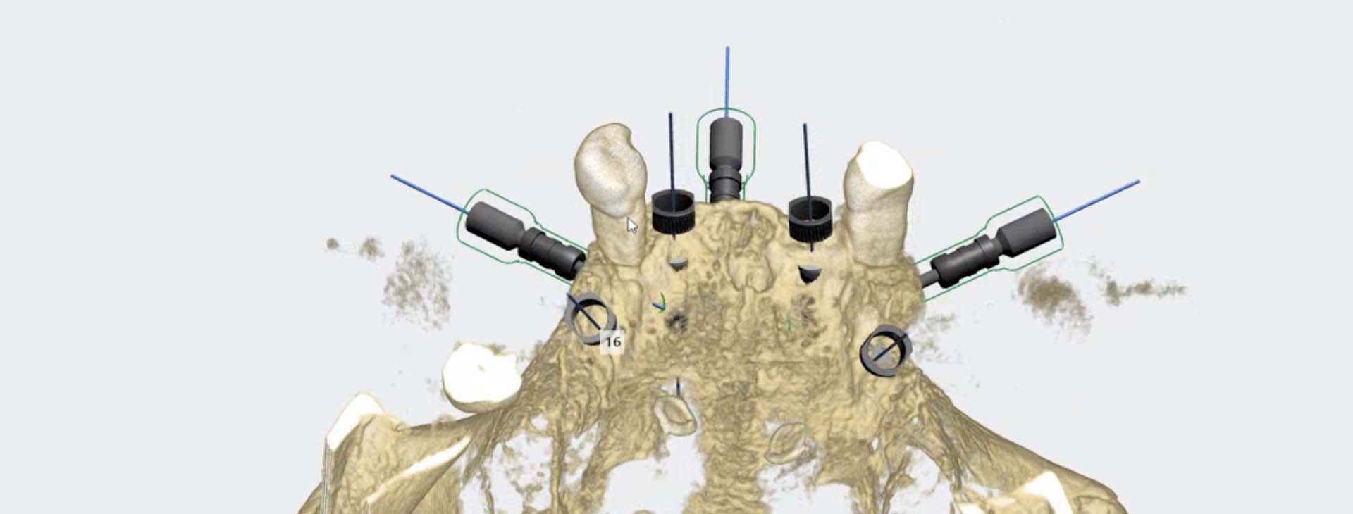 Dental implants for edentulous patients