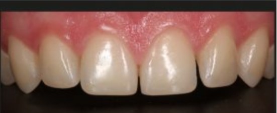 Nudilusių kandamųjų dantų atstatymas po gydymo