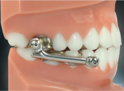 Ortodontiniai aparatai