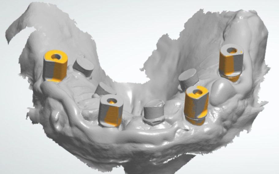 Skaitmeninė dantų implantų padėties registracija