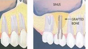 Atviro sinuso dugno pakėlimo procedūros schema (dantų implantacija)