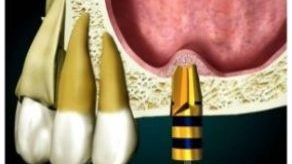 Uždaro sinuso dugno pakėlimo procedūros schema (dantų implantacija)