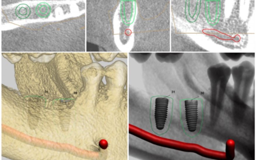 Skaitmeninis dantų implantų planavimas
