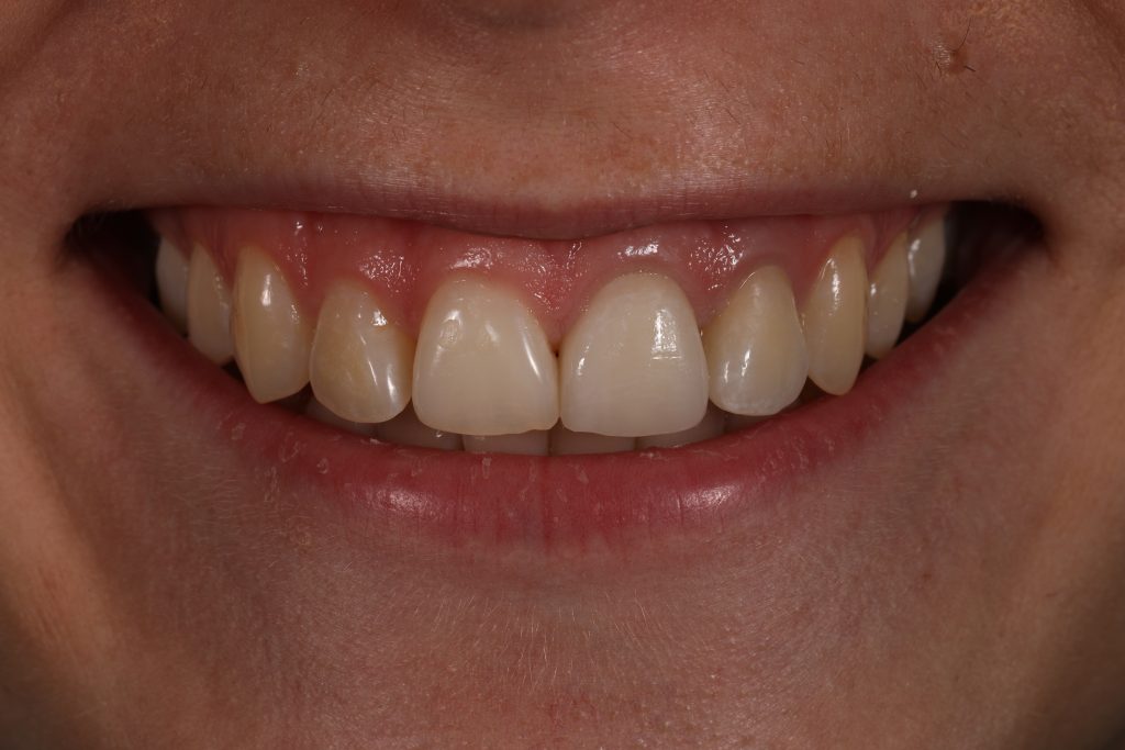 Dantų išvaizda po keraminių laminačių