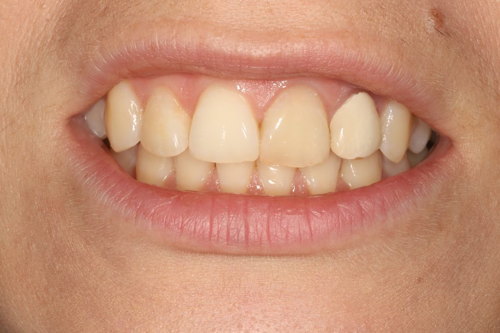 Dantų išvaizda prieš keramines laminates