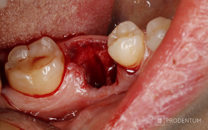 Vaizdas iškart po danties šalinimo, ryškus kaulo defektas iš žandinės pusės.
