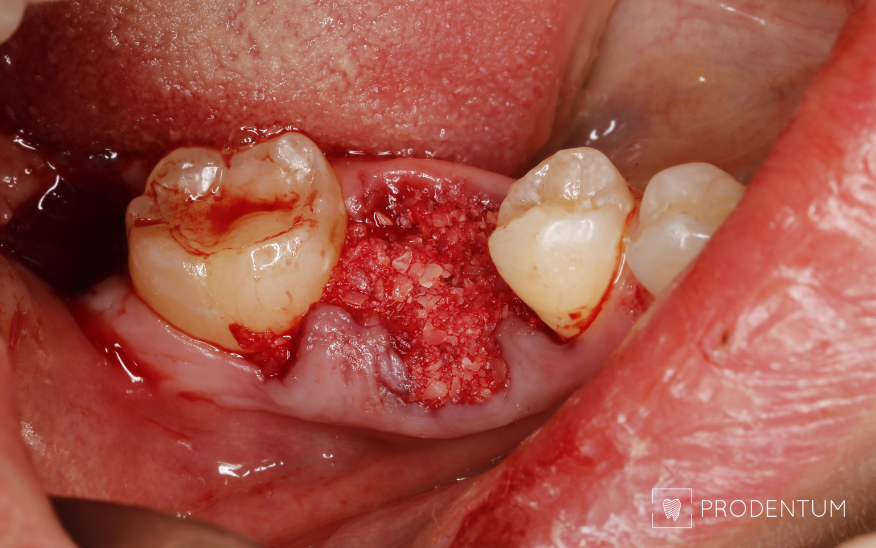 Kaulinis defektas užpildytas kauliniu pakaitalu pagamintu iš neišdygusio protinio danties.
