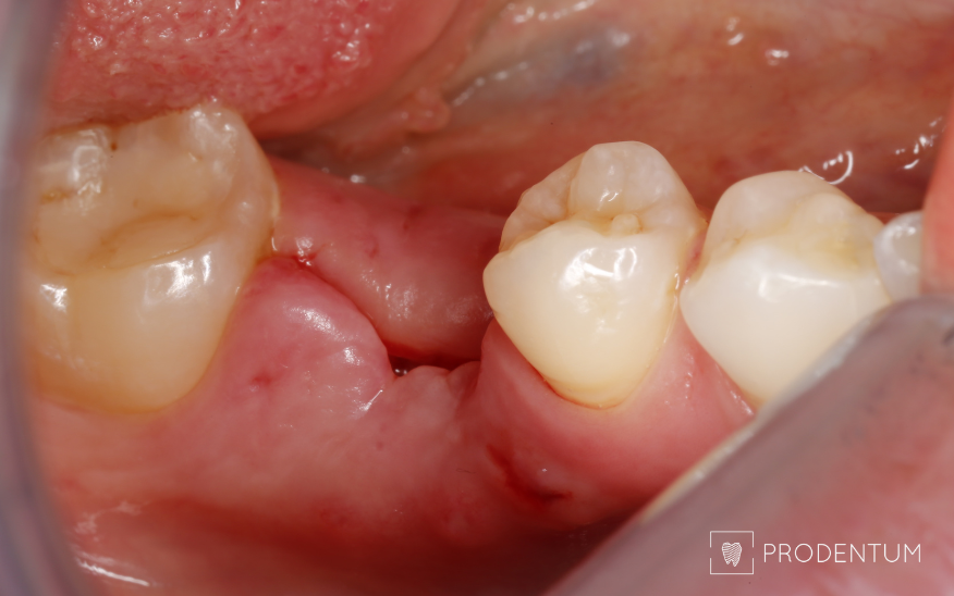 Vaizdas praėjus 2 sav po šalinimo. Po 3 mėn. įsriegtas danties implantas.