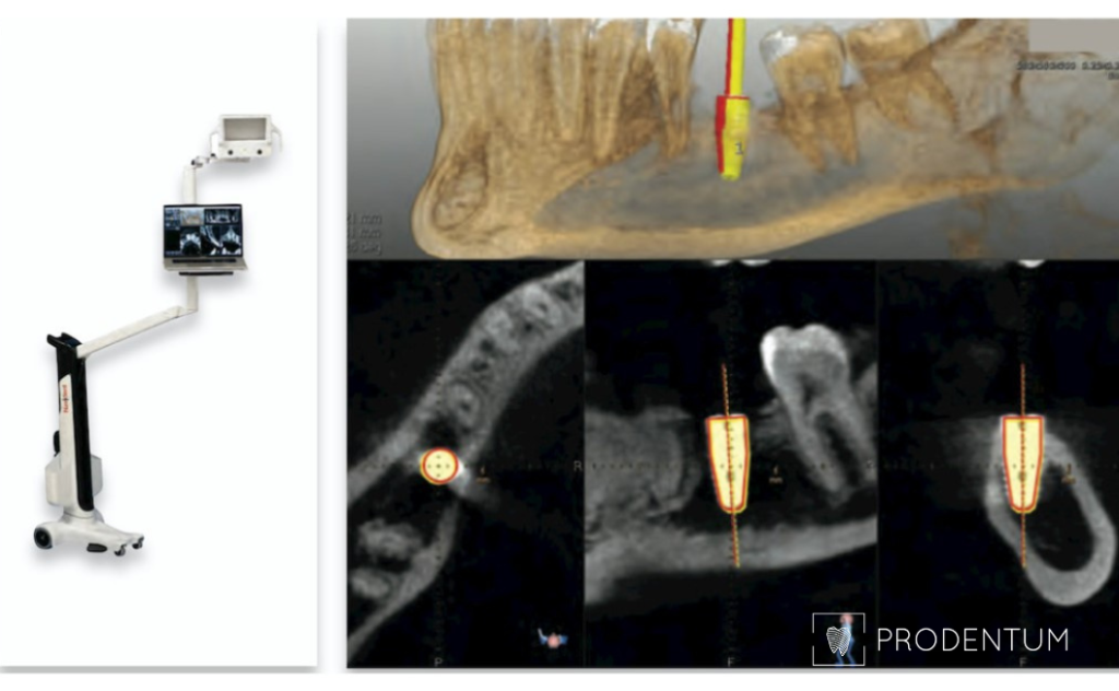 dantų implantacijos virtualus planas atliekamas greitai, to paties vizito metu galima atlikti implantaciją